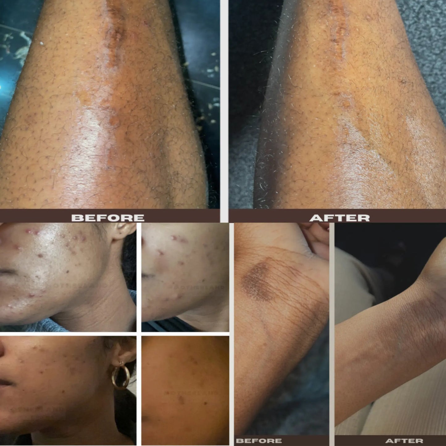 Before and after results showing visible improvement in scars, dark spots, hyperpigmentation, and acne. Skin transformation on shins, face, and arms achieved using the ADUN x KURO combo — a brightening body butter enriched with licorice root, mulberry, and bearberry, paired with an exfoliating coffee scrub for smooth, radiant, and even-toned skin.
